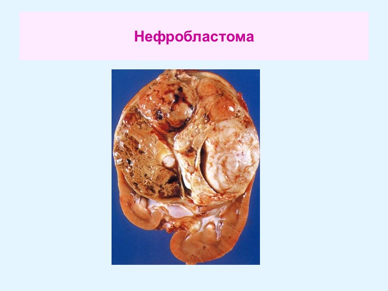 Нефробластома